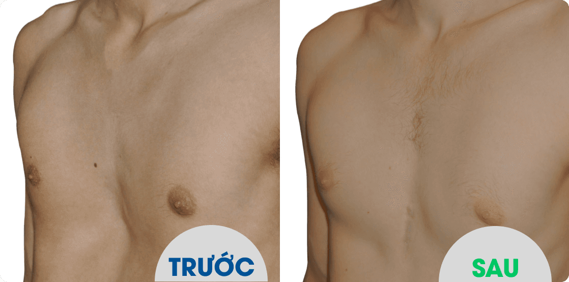 So sánh trước và sau điều trị lõm ngực trên bệnh nhân thứ nhất.