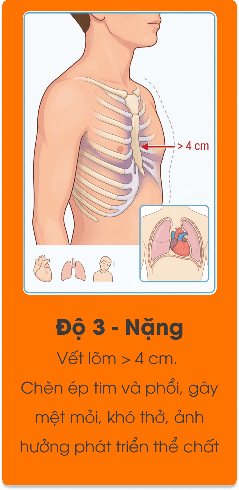 Minh họa mức độ lõm ngực độ 3.